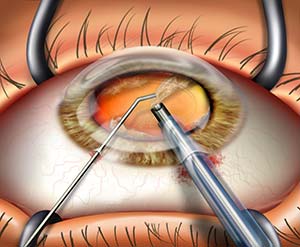Cataract Surgery