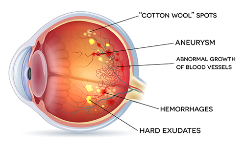 Diabetic Retinopathy